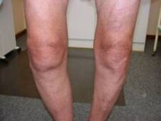 Symptômes de l'arthrose de l'articulation du genou