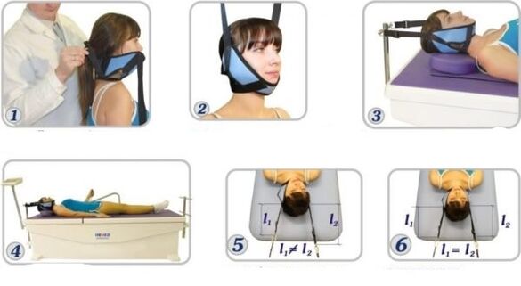 Traitement de l'ostéochondose cervicale avec élimination