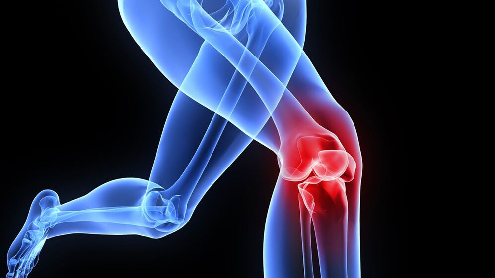 Problèmes de genoux dus à l'arthrose.